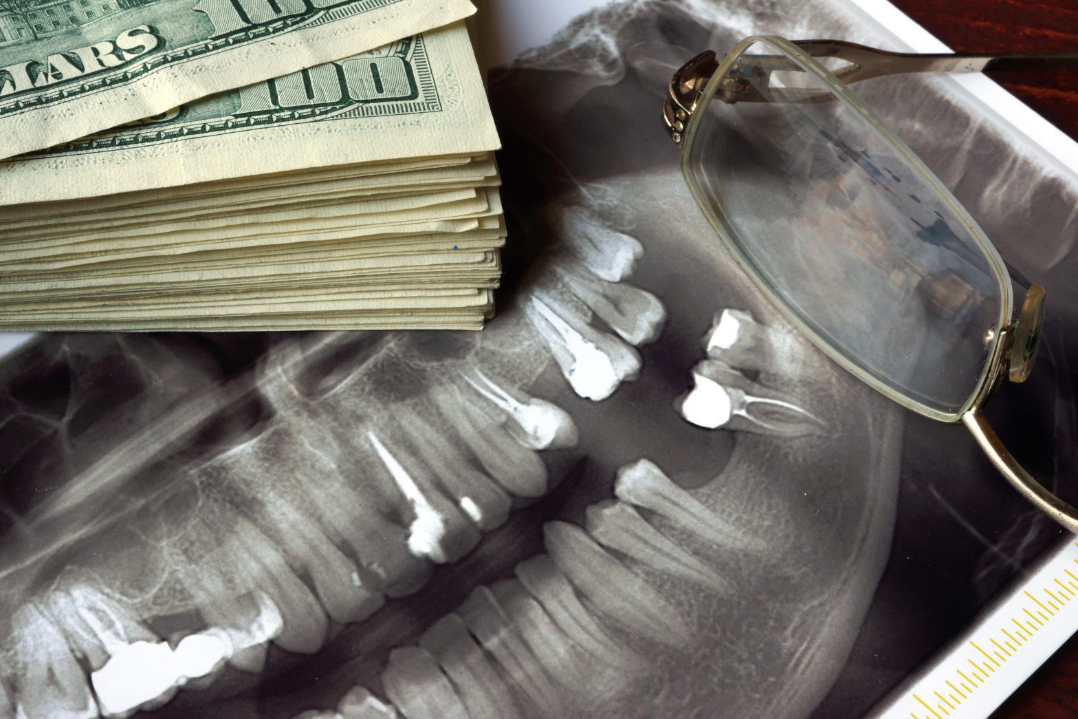 expensive dental implants